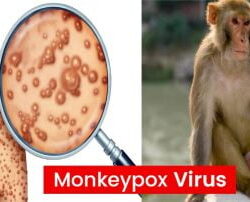 First case of monkeypox confirmed in British Columbia